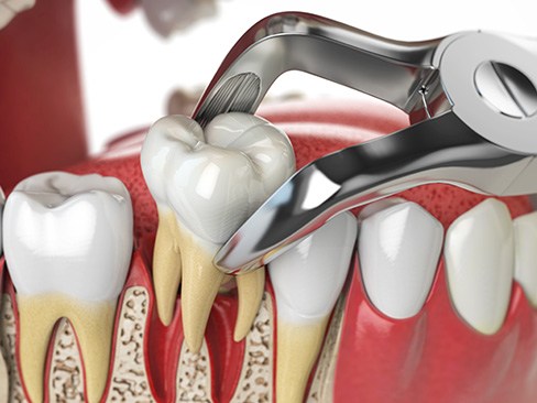 Illustration of forceps being used to remove a tooth