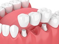 a 3D depiction of a traditional dental bridge