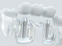 a 3D illustration of an implant bridge