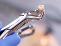 Closeup of forceps grasping extracted tooth