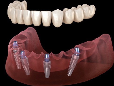 Animated dental implant-retained denture