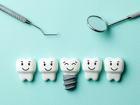 Illustration of dental implant in Dallas
