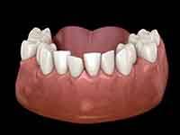 An example of crowded teeth in Dallas