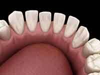 An example of gapped teeth in Dallas