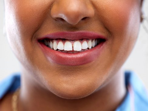 A woman with a gap between her two front teeth before Invisalign treatment